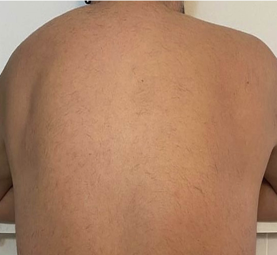 After Four Treatments