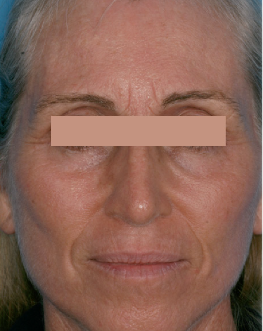After one Treatment