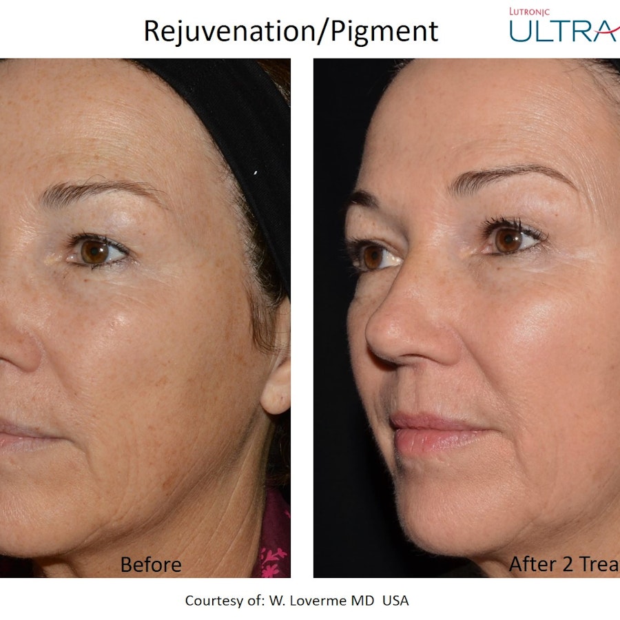 LuxeGlow Refresh skin glow and rejuvenation treatment at Luxederm