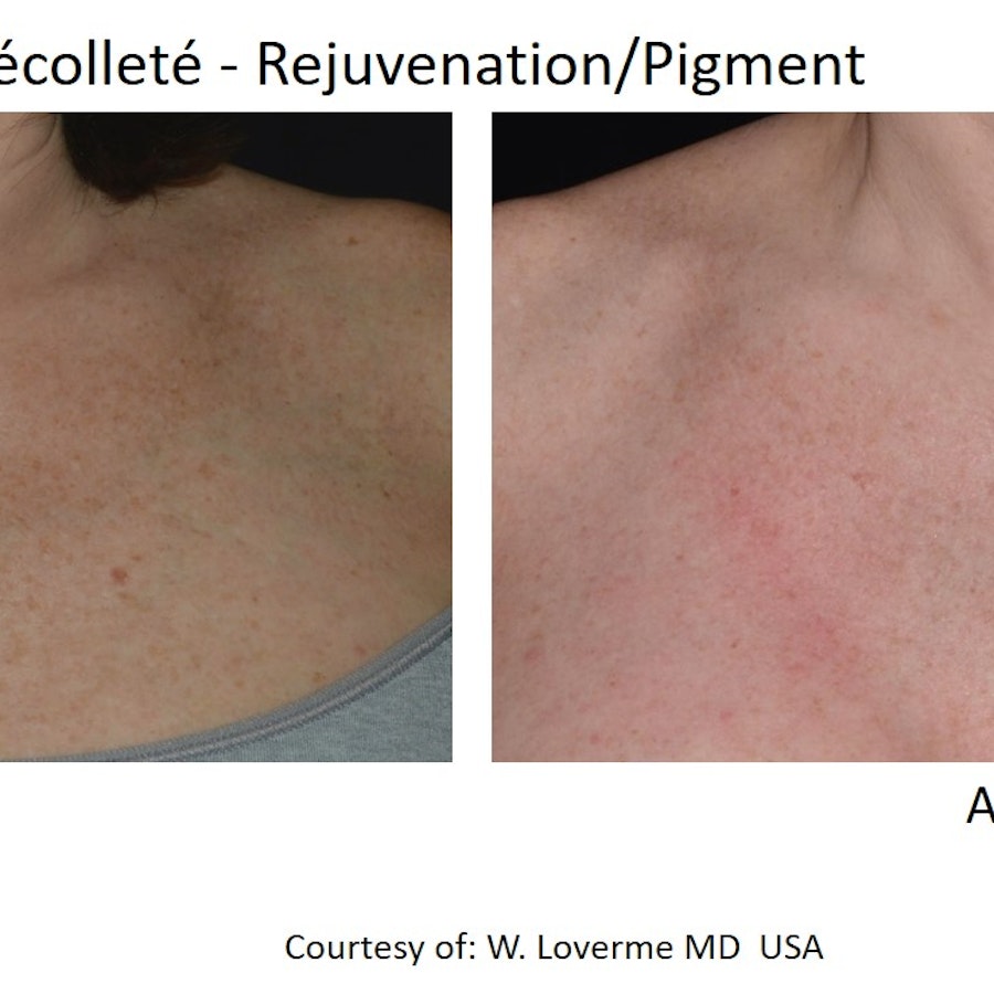 LuxeTone Correct pigmentation, melasma and uneven skin tone treatment at Luxederm